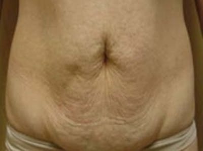 Body Sculpting Before & After Gallery - Patient 20493199 - Image 1
