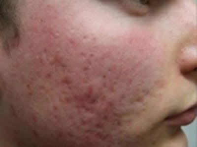 Scar Removal Before & After Gallery - Patient 20493200 - Image 1
