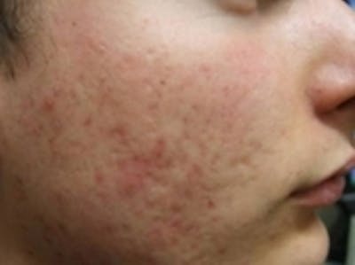 Scar Removal Before & After Gallery - Patient 20493200 - Image 2