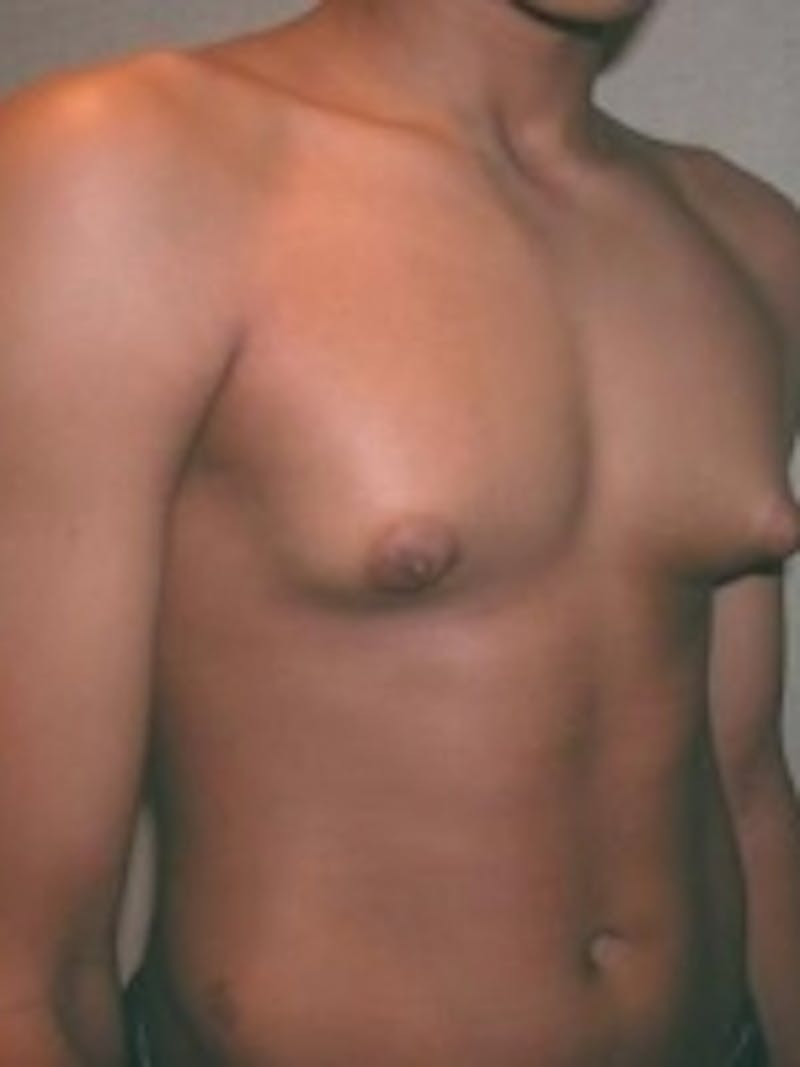 Body Sculpting Before & After Gallery - Patient 20493201 - Image 1