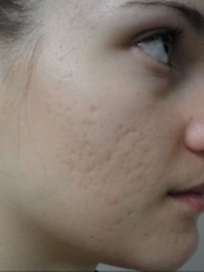 Scar Removal Before & After Gallery - Patient 20493202 - Image 1