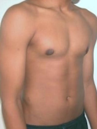 Body Sculpting Before & After Gallery - Patient 20493201 - Image 2