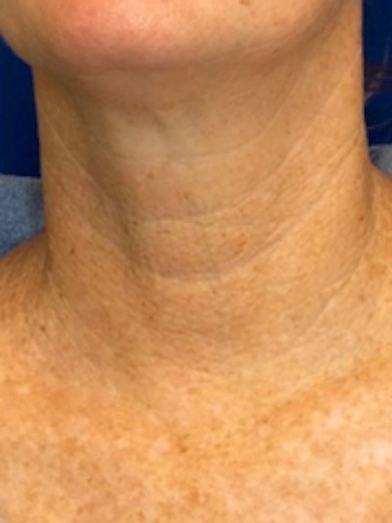 Vivace RF Microneedling Before & After Gallery - Patient 20493204 - Image 1