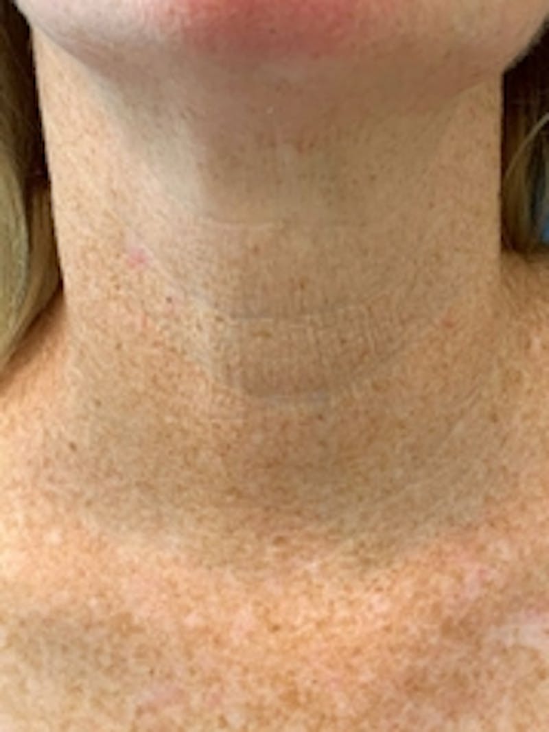 Vivace RF Microneedling Before & After Gallery - Patient 20493204 - Image 2