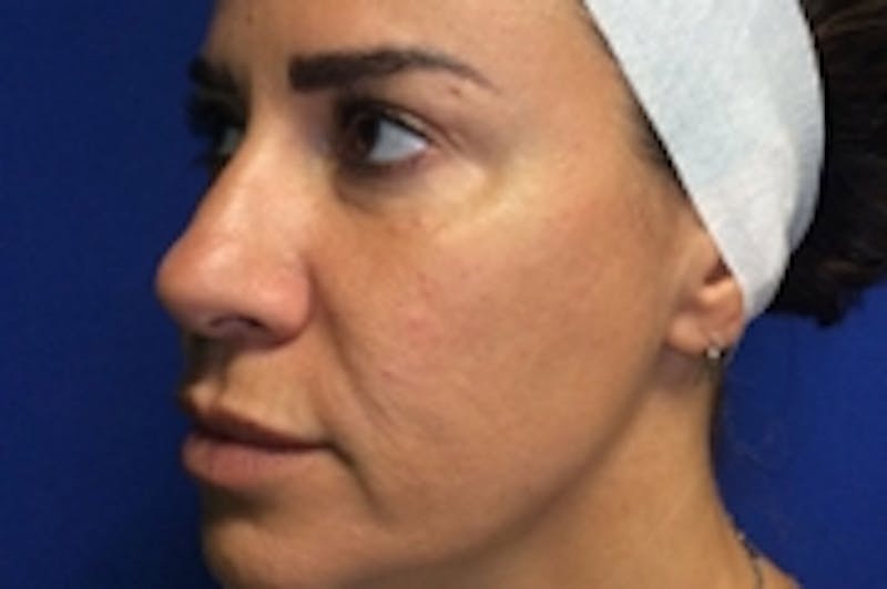 Vivace RF Microneedling Before & After Gallery - Patient 20493205 - Image 2