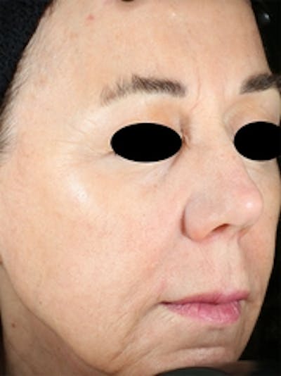 Vivace RF Microneedling Before & After Gallery - Patient 20493206 - Image 2