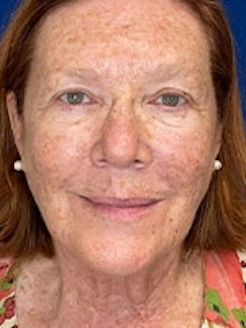 Facial Laser Treatments Before & After Gallery - Patient 20493207 - Image 1