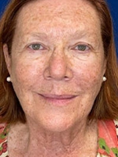 Facial Laser Treatments Before & After Gallery - Patient 20493207 - Image 1