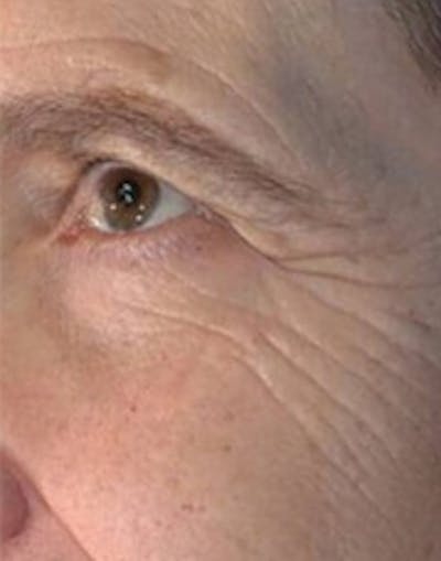 Vivace RF Microneedling Before & After Gallery - Patient 20493211 - Image 1