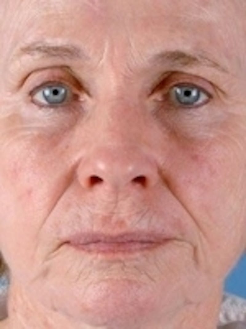 Facial Laser Treatments Before & After Gallery - Patient 20493232 - Image 1
