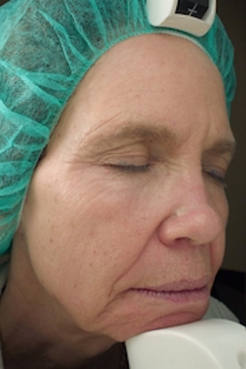 Vivace RF Microneedling Before & After Gallery - Patient 20493231 - Image 2