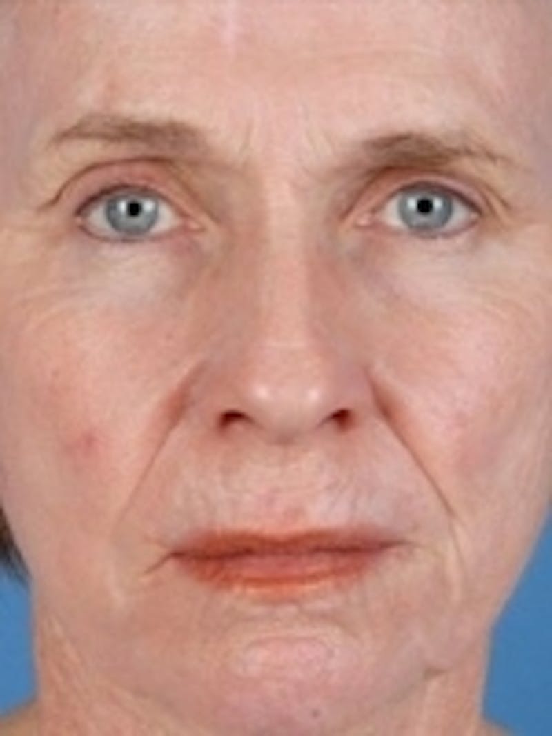 Facial Laser Treatments Before & After Gallery - Patient 20493232 - Image 2