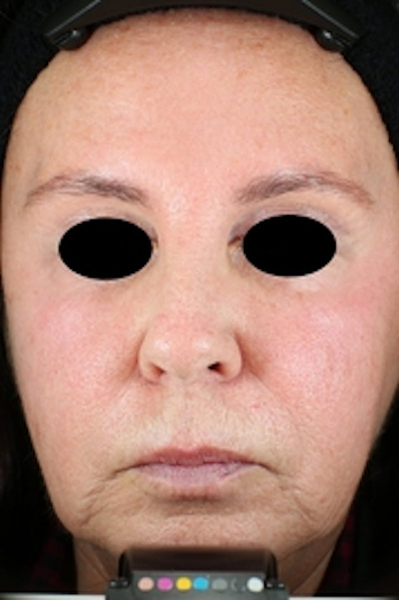 Vivace RF Microneedling Before & After Gallery - Patient 20493233 - Image 1