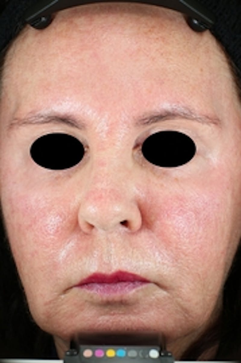 Vivace RF Microneedling Before & After Gallery - Patient 20493233 - Image 2