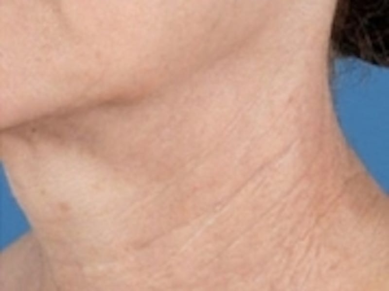 Facial Laser Treatments Before & After Gallery - Patient 20493234 - Image 2