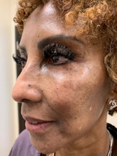 Dermal Fillers Before & After Gallery - Patient 20493238 - Image 2