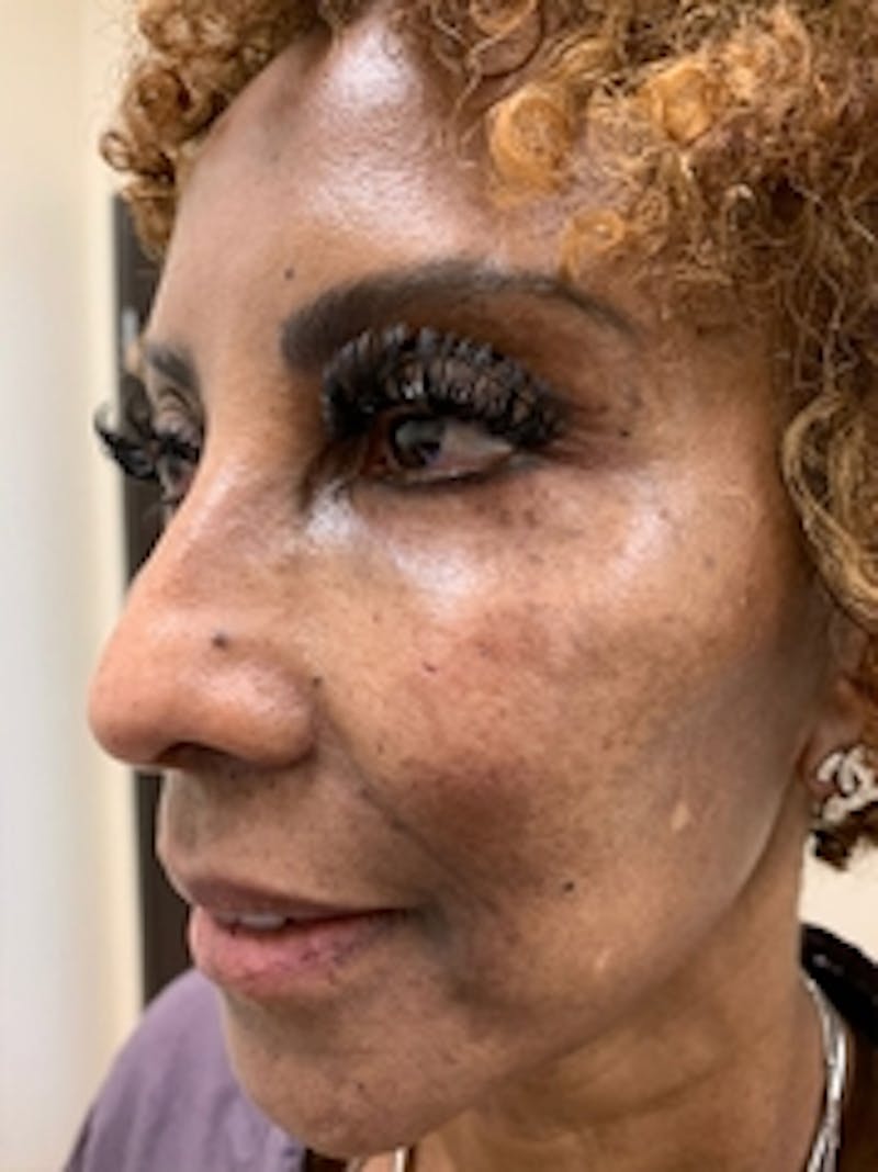 Dermal Fillers Before & After Gallery - Patient 20493238 - Image 2