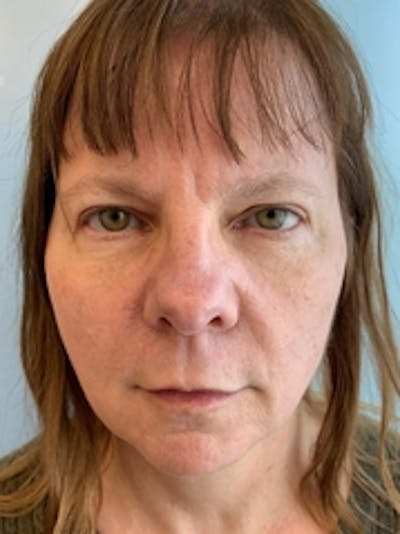 Dermal Fillers Before & After Gallery - Patient 20493240 - Image 1