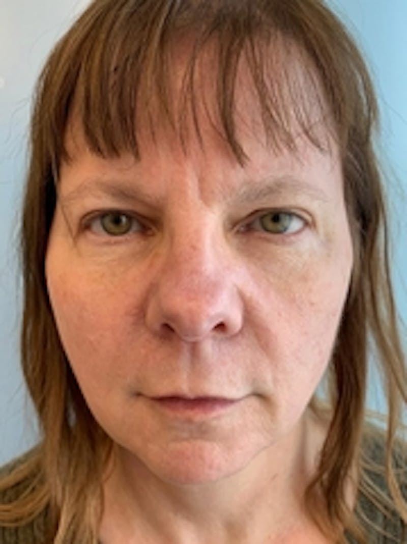 Dermal Fillers Before & After Gallery - Patient 20493240 - Image 1