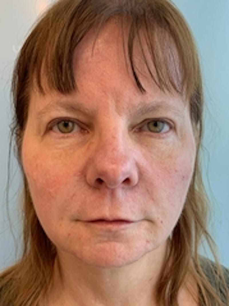 Dermal Fillers Before & After Gallery - Patient 20493240 - Image 2