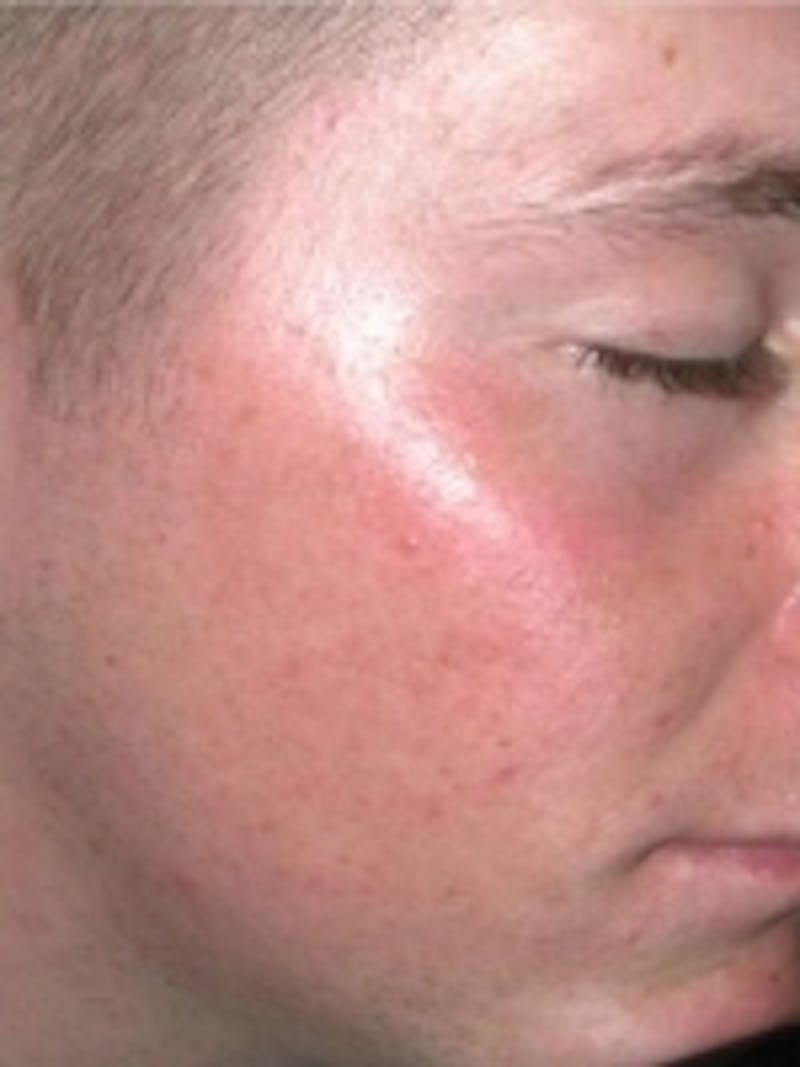 Acne Treatment Before & After Gallery - Patient 20493241 - Image 2