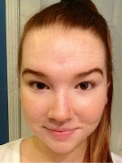 Acne Treatment Before & After Gallery - Patient 20493246 - Image 2