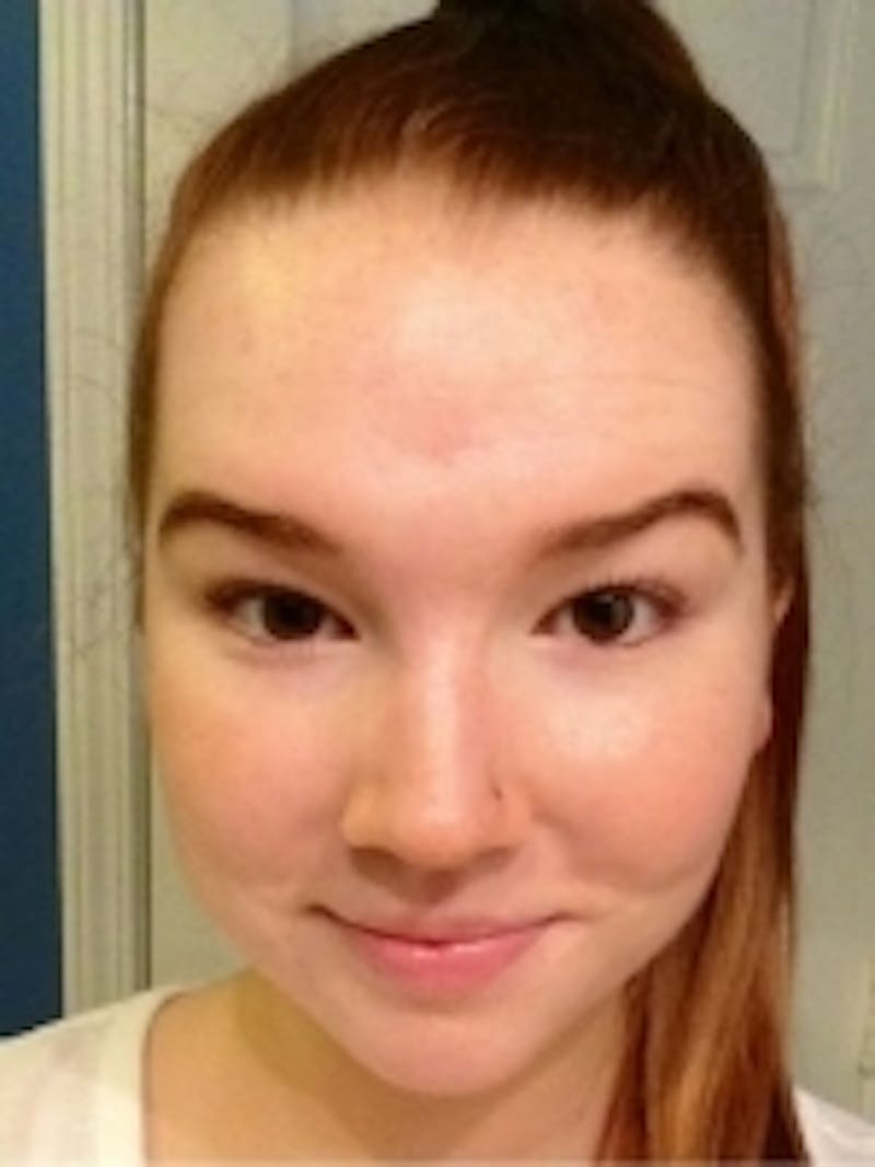 Acne Treatment Before & After Gallery - Patient 20493246 - Image 2
