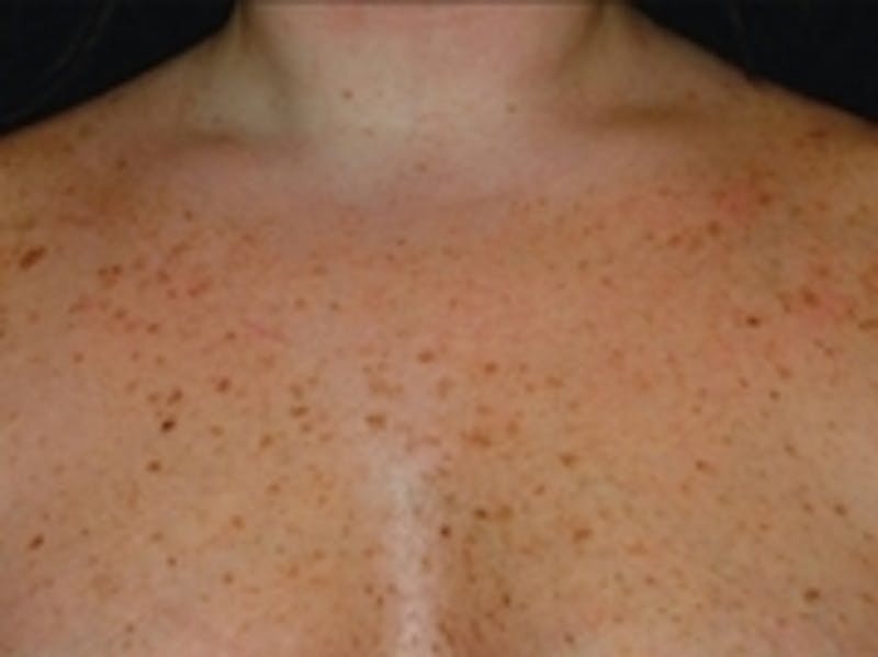 Cosmetic Dermatology Before & After Gallery - Patient 20493248 - Image 1