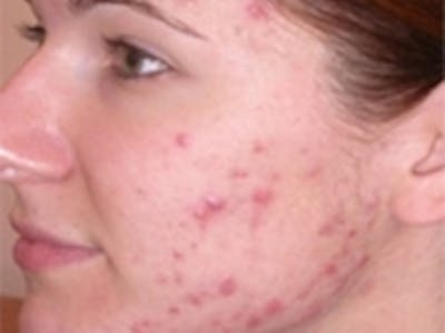 Acne Treatment Before & After Gallery - Patient 20493250 - Image 1