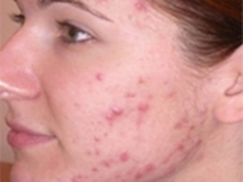 Acne Treatment Before & After Gallery - Patient 20493250 - Image 1