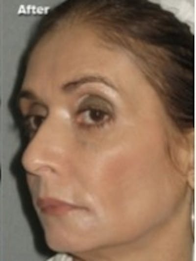 Dermal Fillers Before & After Gallery - Patient 20493249 - Image 2