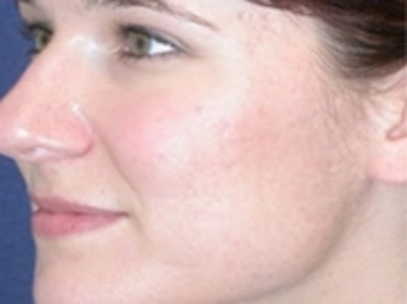 Acne Treatment Before & After Gallery - Patient 20493250 - Image 2