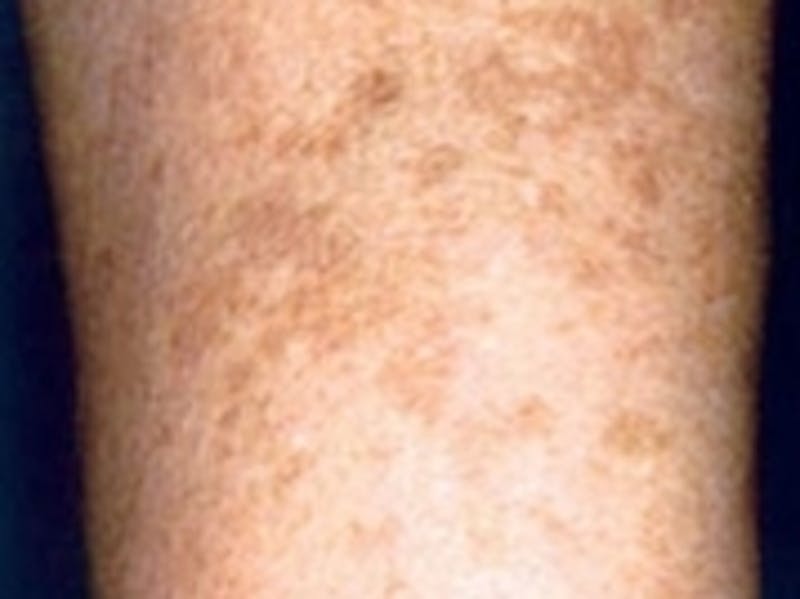 Cosmetic Dermatology Before & After Gallery - Patient 20493251 - Image 1