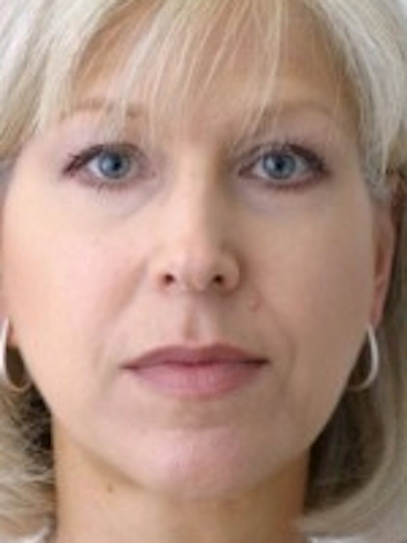 Dermal Fillers Before & After Gallery - Patient 20493255 - Image 1