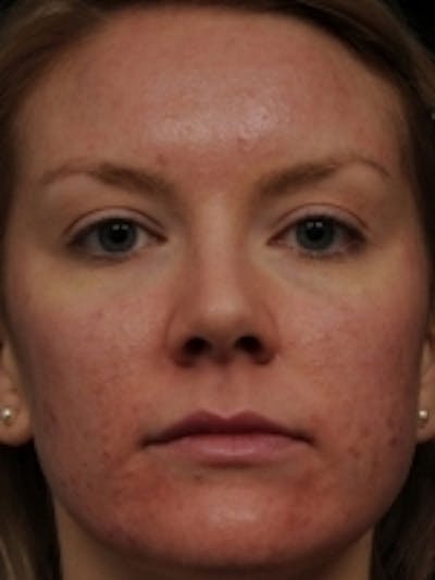 Acne Treatment Before & After Gallery - Patient 20493256 - Image 1