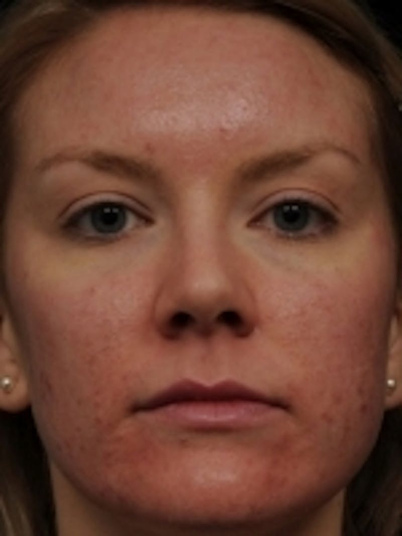 Acne Treatment Before & After Gallery - Patient 20493256 - Image 1