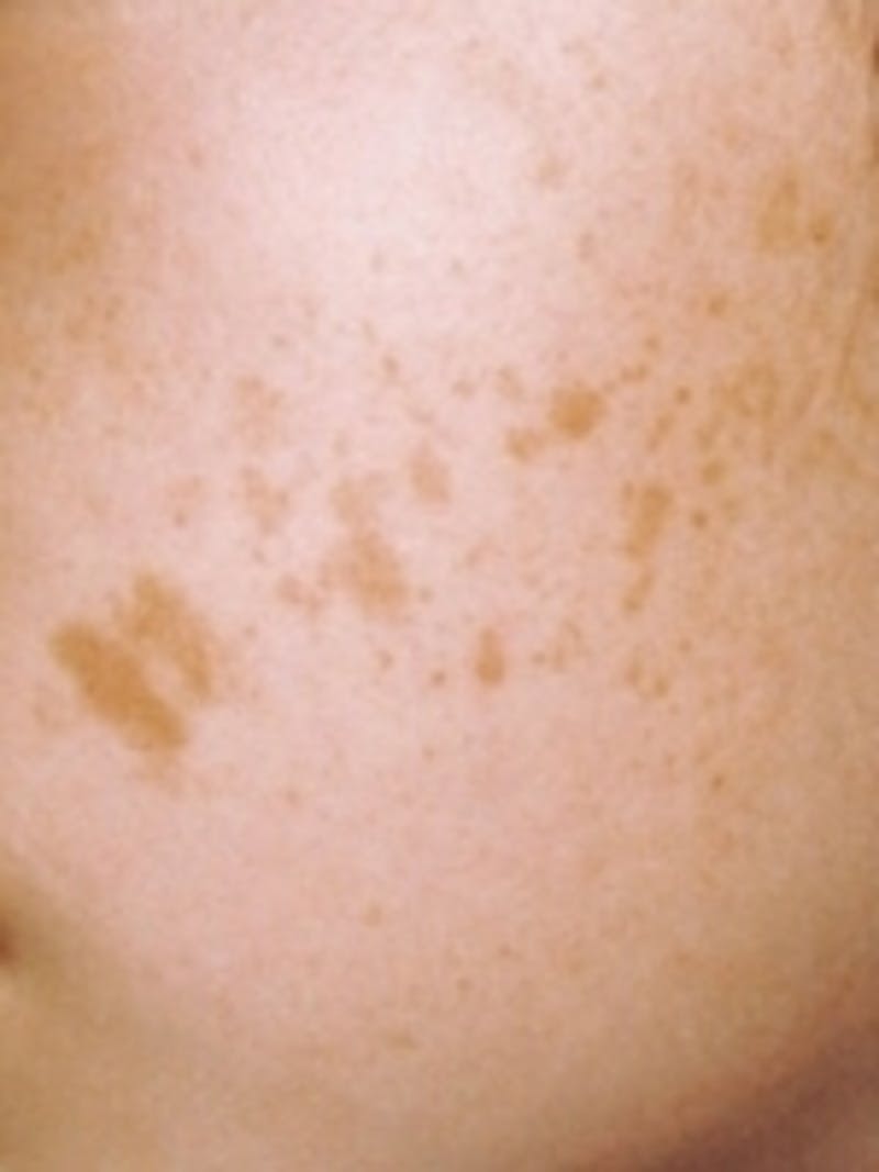 Cosmetic Dermatology Before & After Gallery - Patient 20493257 - Image 1