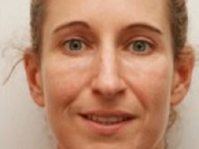 Dermal Fillers Before & After Gallery - Patient 20493258 - Image 2