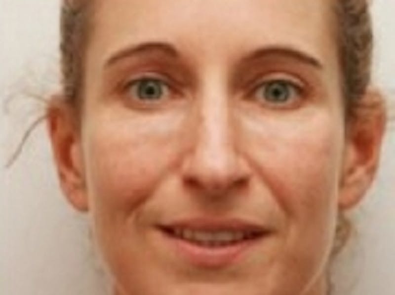 Dermal Fillers Before & After Gallery - Patient 20493258 - Image 2
