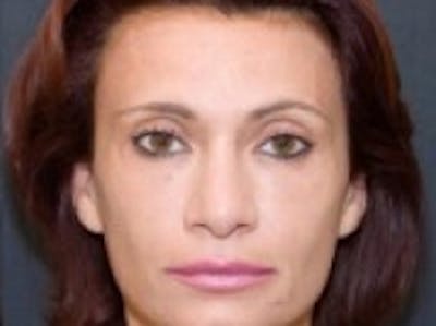 Dermal Fillers Before & After Gallery - Patient 20493260 - Image 2