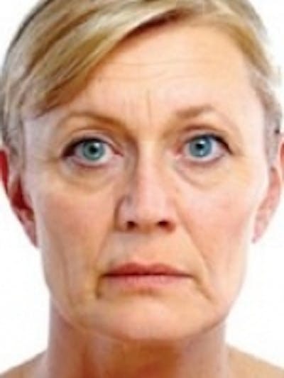 Dermal Fillers Before & After Gallery - Patient 20493262 - Image 1