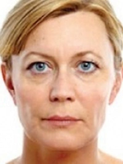 Dermal Fillers Before & After Gallery - Patient 20493262 - Image 2
