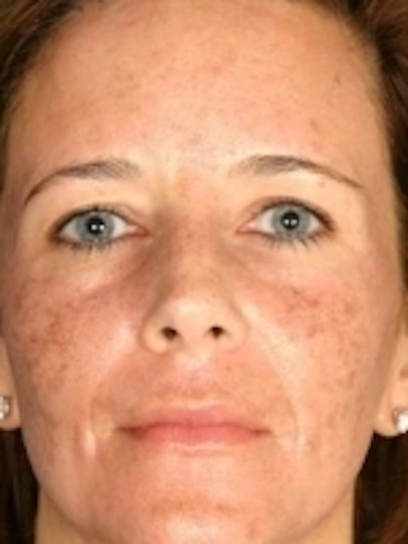 Cosmetic Dermatology Before & After Gallery - Patient 20493265 - Image 1