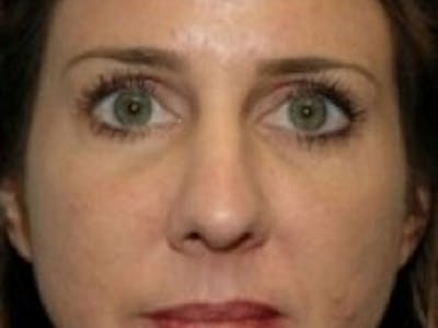 Dermal Fillers Before & After Gallery - Patient 20493266 - Image 2