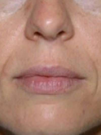 Dermal Fillers Before & After Gallery - Patient 20493270 - Image 1