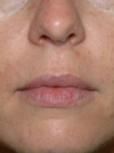 Dermal Fillers Before & After Gallery - Patient 20493270 - Image 2