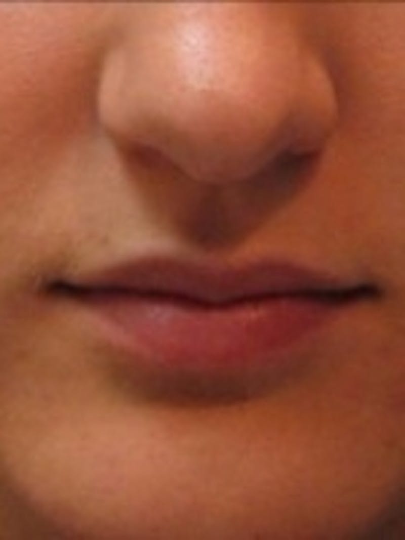 Dermal Fillers Before & After Gallery - Patient 20493272 - Image 1