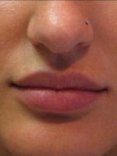 Dermal Fillers Before & After Gallery - Patient 20493272 - Image 2