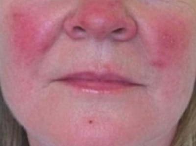 Cosmetic Dermatology Before & After Gallery - Patient 20493273 - Image 1