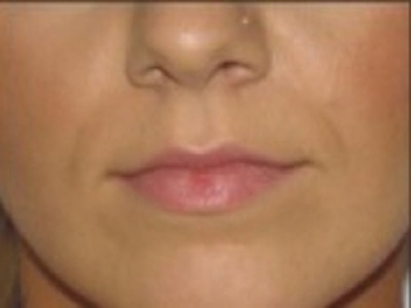 Dermal Fillers Before & After Gallery - Patient 20493274 - Image 1